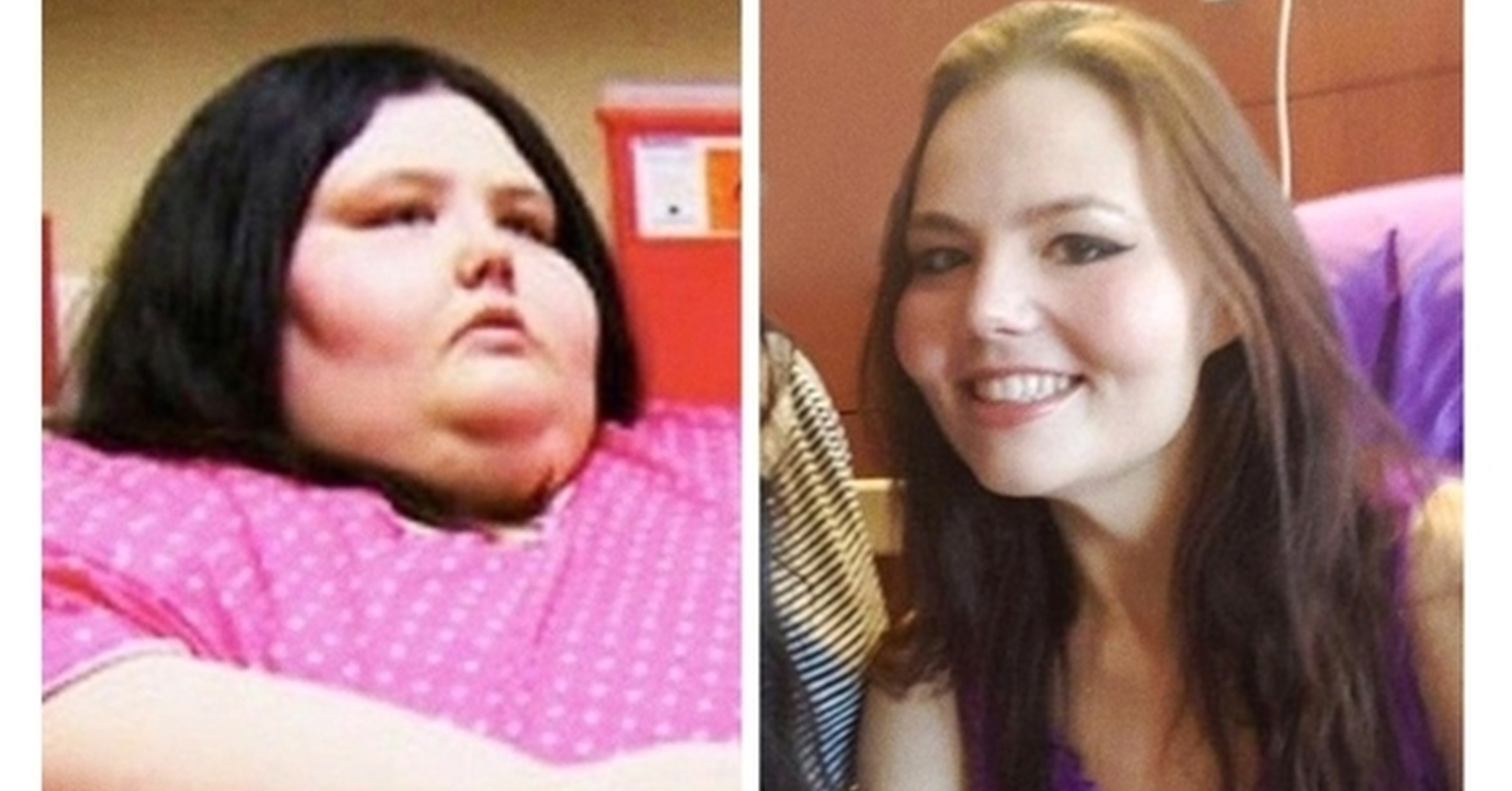 Obesidad antes y despues de adelgazar